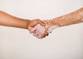 img-01-free-img Crop anonymous man shaking hand of male friend with vitiligo skin against white background