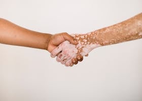 img-02-free-img Crop anonymous man shaking hand of male friend with vitiligo skin against white background